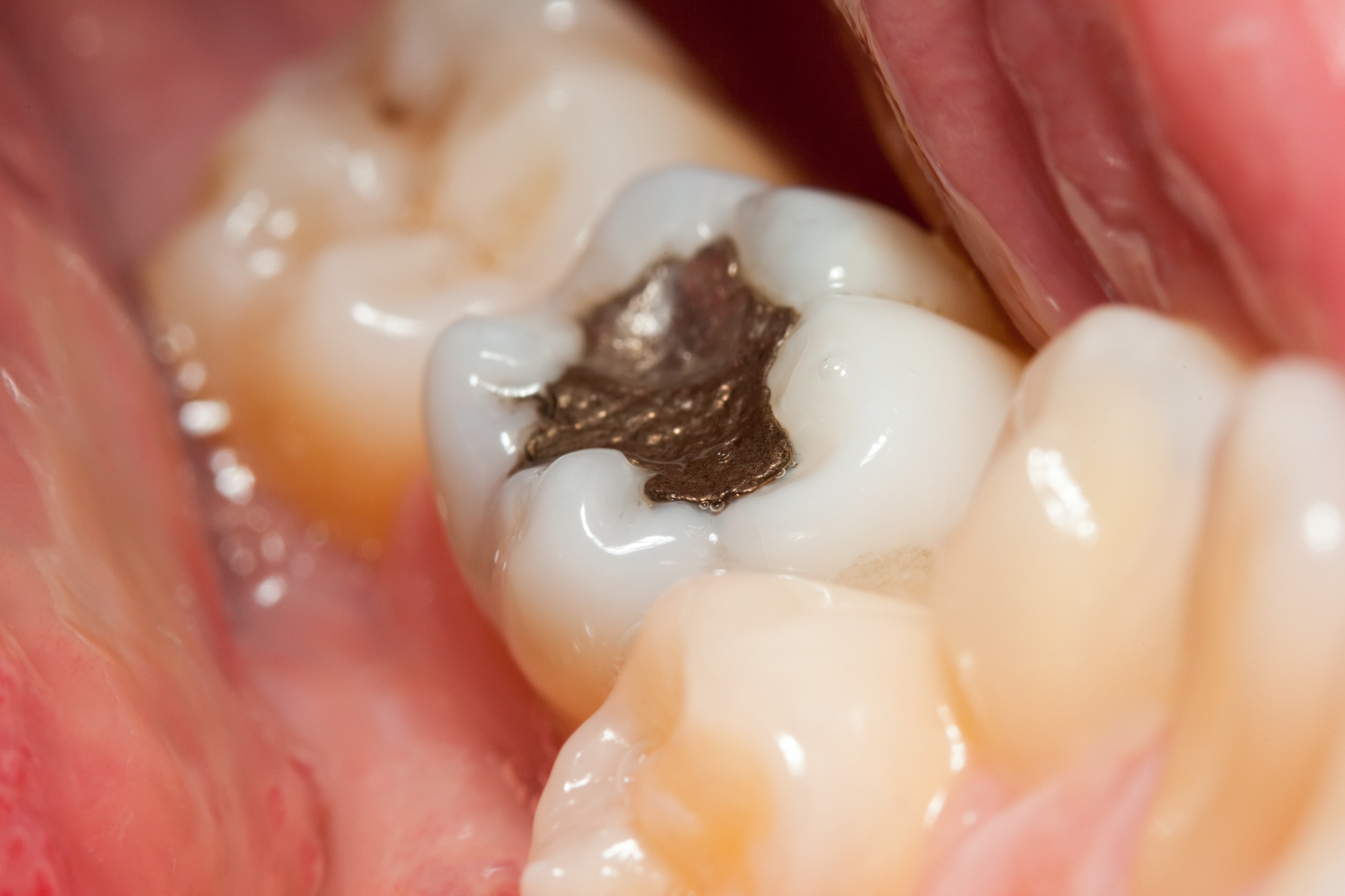 What is the difference between an amalgam filling and a composite filling? Learn more now